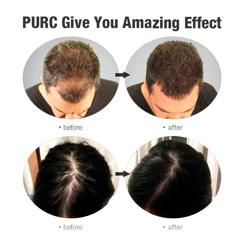 PURC Fast Hair Growth Shampoo Conditioner Thickener Anti Loss Hair Grow Shampoo Set Scalp Treatments Hair Care Products 600ml